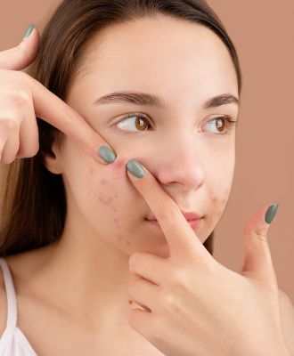 Acne Treatment In Dubai
