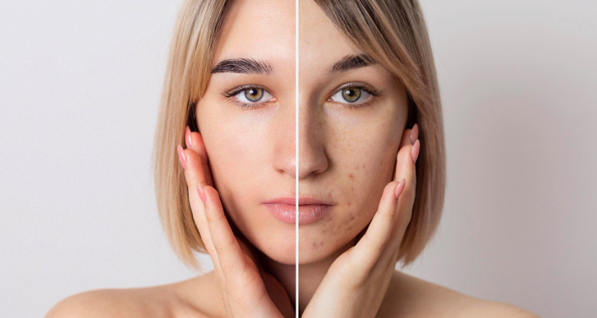 Pigmentation Treatment In Dubai
