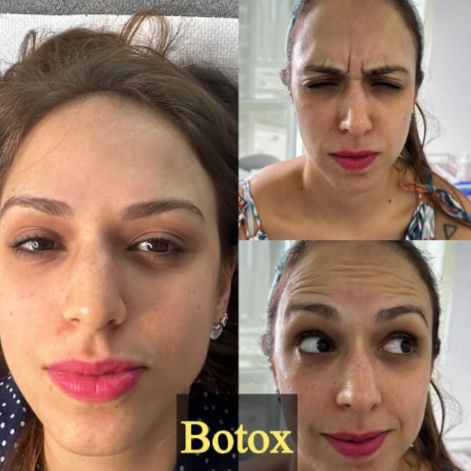 Before After Botox