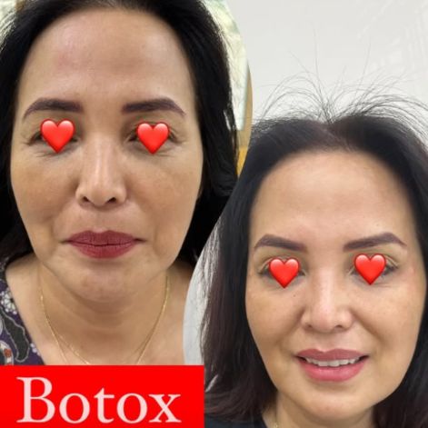Botox