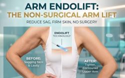 Arm Endolift in Dubai