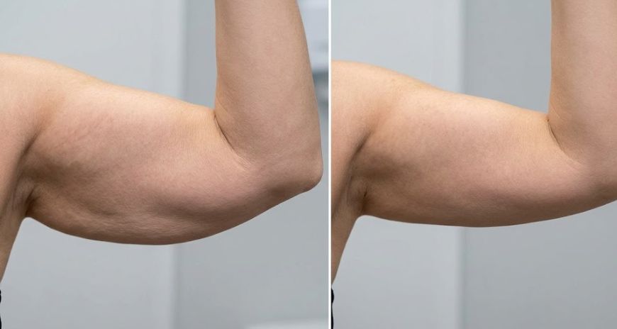 Arm Endolift in Dubai