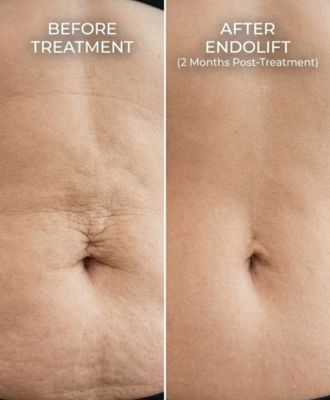 Endolift for Tummy