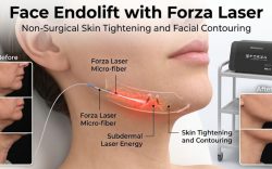 Face Endolift