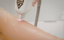 Laser Hair Removal Treatment