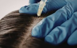 PRP Hair Treatment
