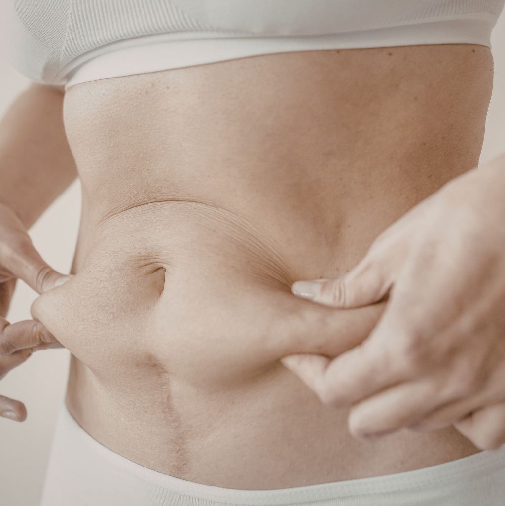 Restoring Abdominal Firmness