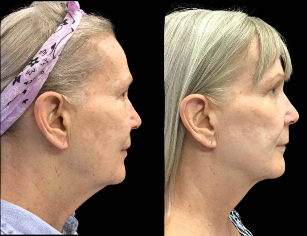 65-year-old-female-kybella-before-and-after-1-2.jpg-2 (1)