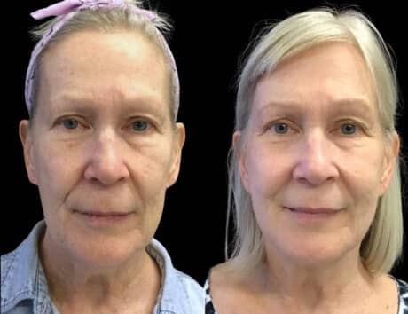 65-year-old-female-kybella-before-and-after-2.jpg-2-460x354 (1)