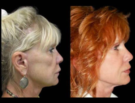 70-year-old-female-non-surgical-cheek-augmentation-before-and-after-1-1.jpg-1-460x354 (1)