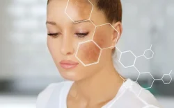 Hyperpigmentation Treatment in Dubai