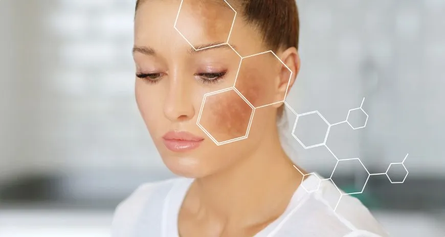 Hyperpigmentation Treatment in Dubai