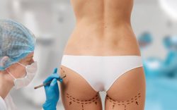 Non-Surgical Butt