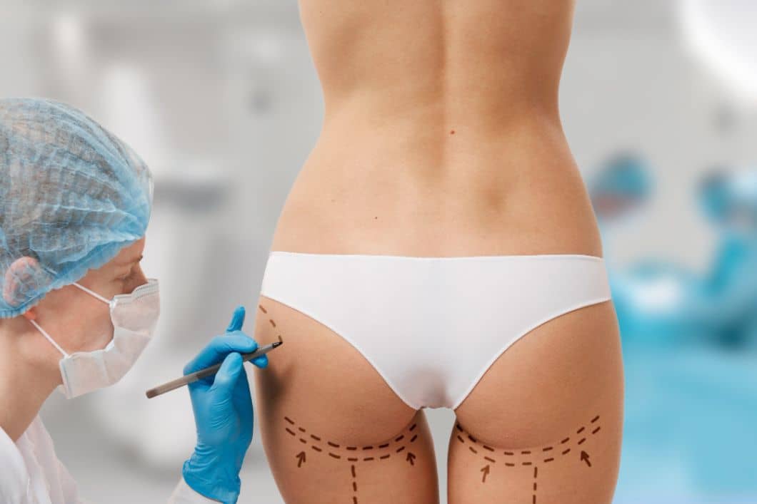 Non-Surgical Butt