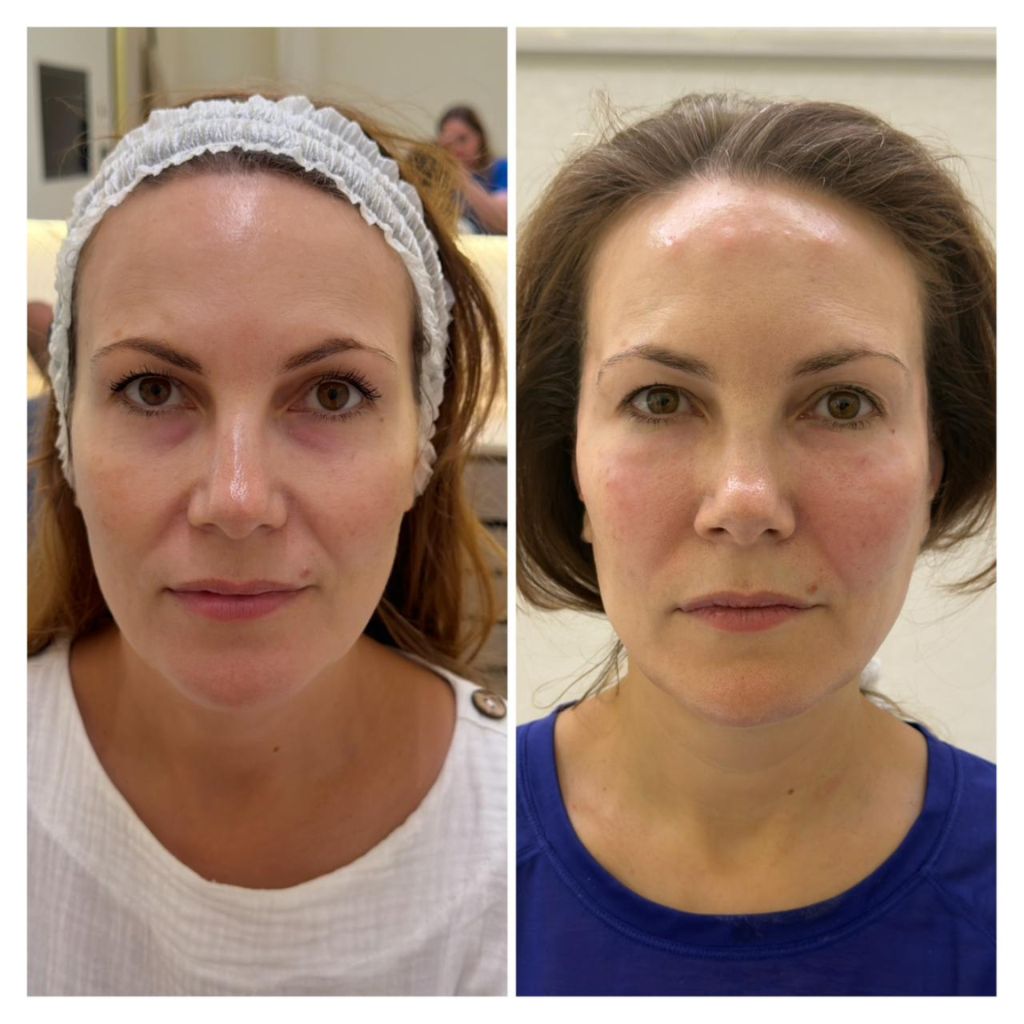 Plasma Gel