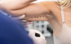 Sculpted Arms Endolift