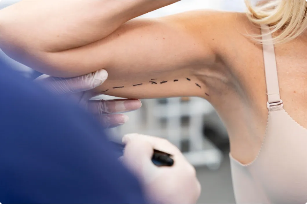 Sculpted Arms Endolift