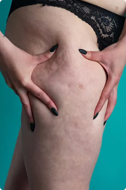 Early Signs of Lipedema Every Woman Should Know