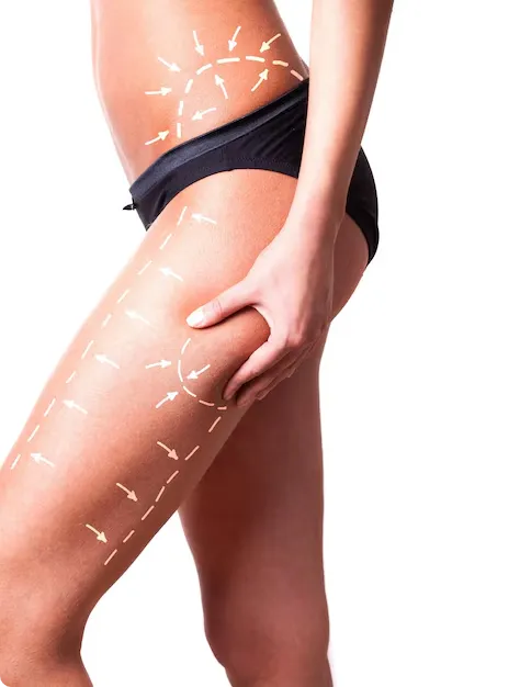 Endolift Cellulite Treatment in Dubai