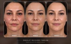 Endolift Recovery Timeline