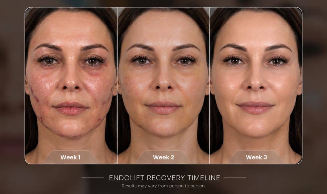 Endolift Recovery Timeline