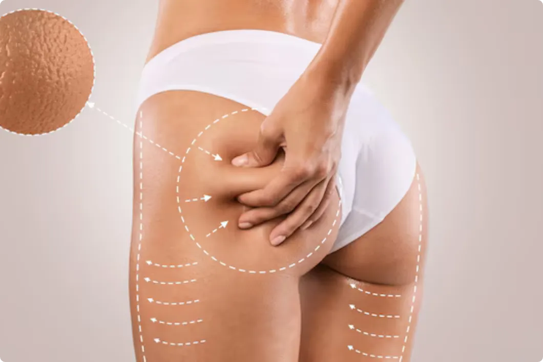 Endolift for Cellulite