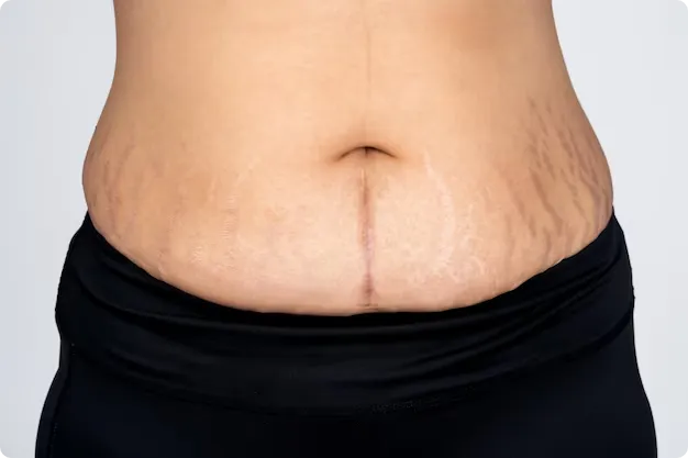 Endolift for postpartum tummy skin