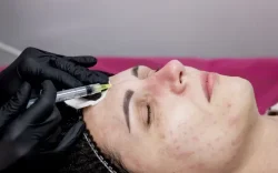 Platelet-Rich Plasma Treatment for Acne Scars