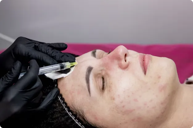 Platelet-Rich Plasma Treatment for Acne Scars