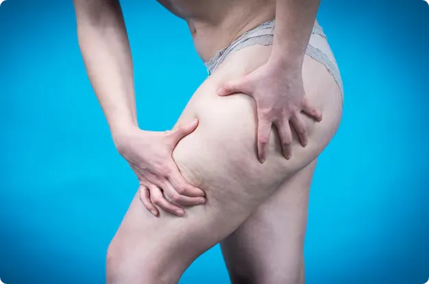 What Is Lipedema