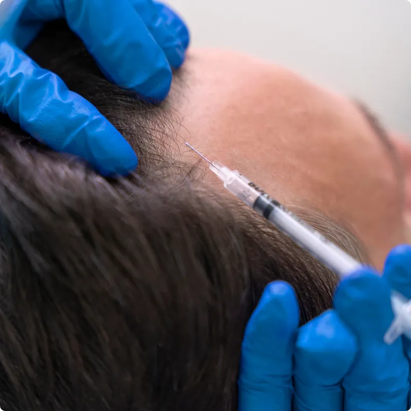 platelet-rich plasma therapy