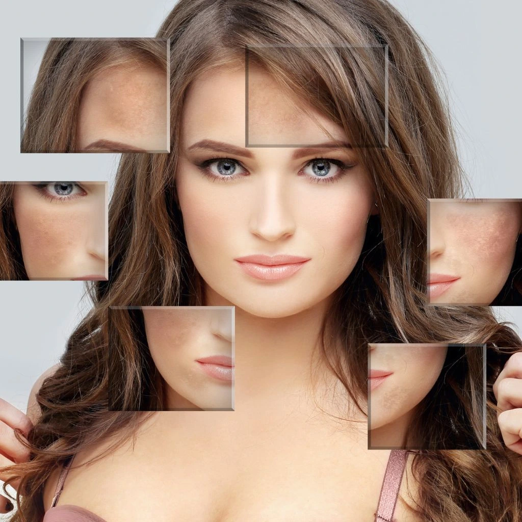 Acne Scars Treatment