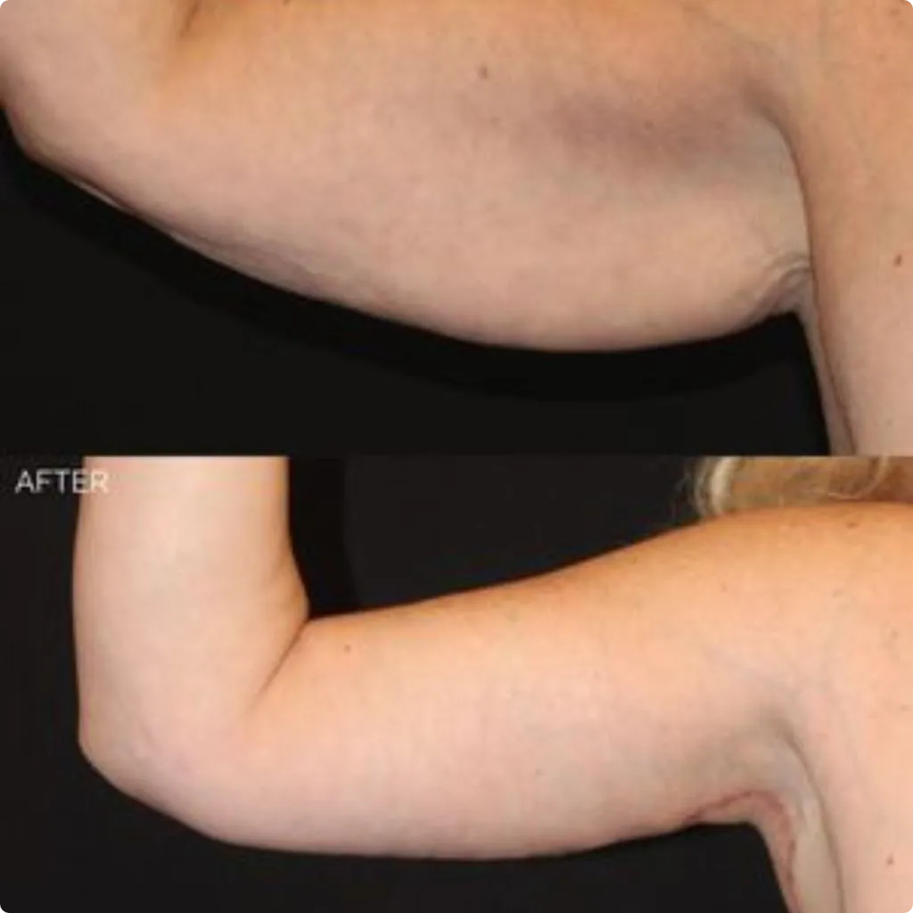 After Endolift arm treatment showing tightened