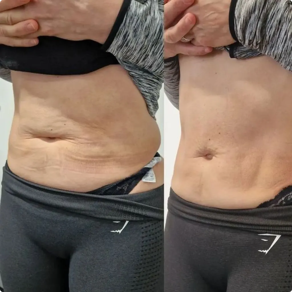 After Endolift tummy treatment showing tightened abdominal skin in Dubai