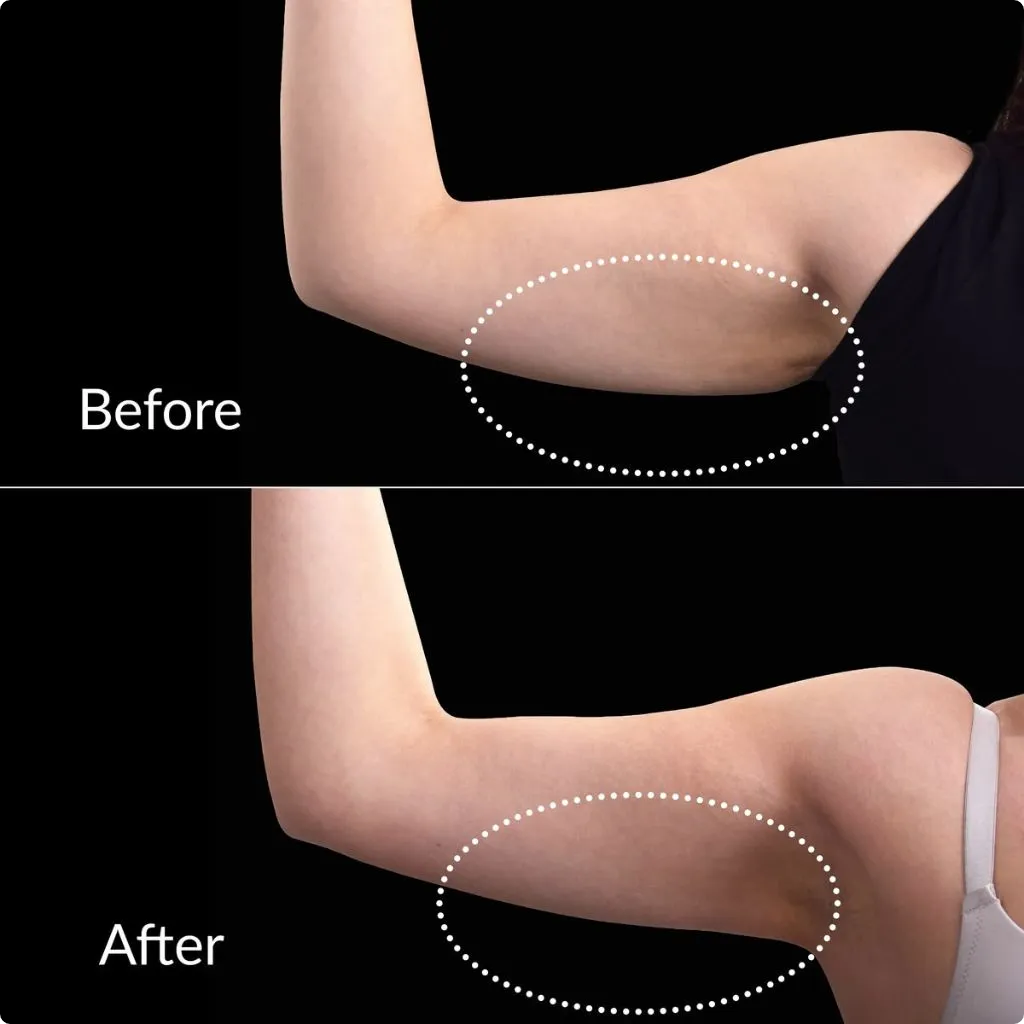 After Endolift arm treatment showing tightened