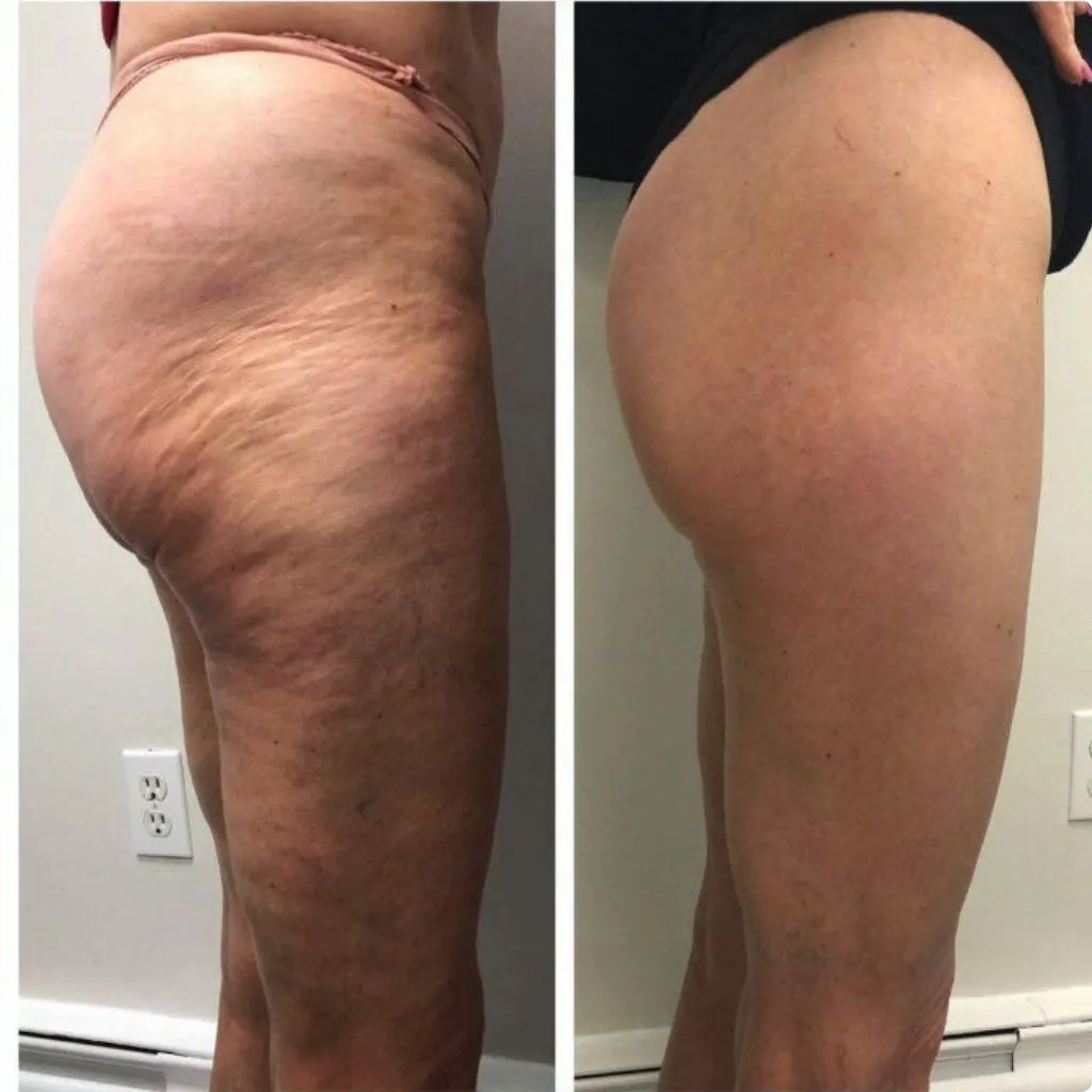 Before Endolift cellulite treatment