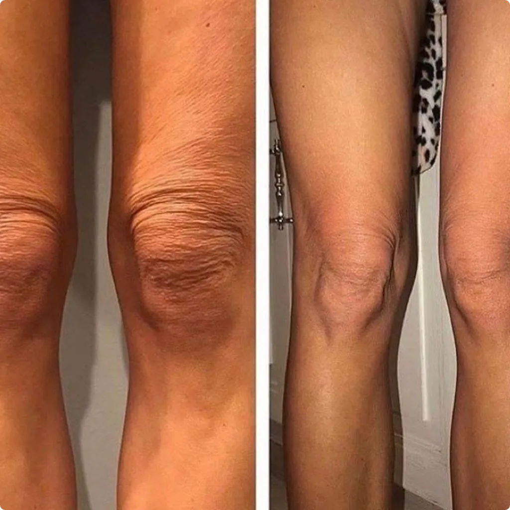 Before Endolift knee treatment