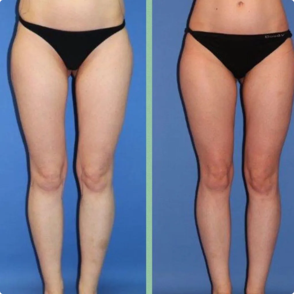 Before Endolift leg treatment