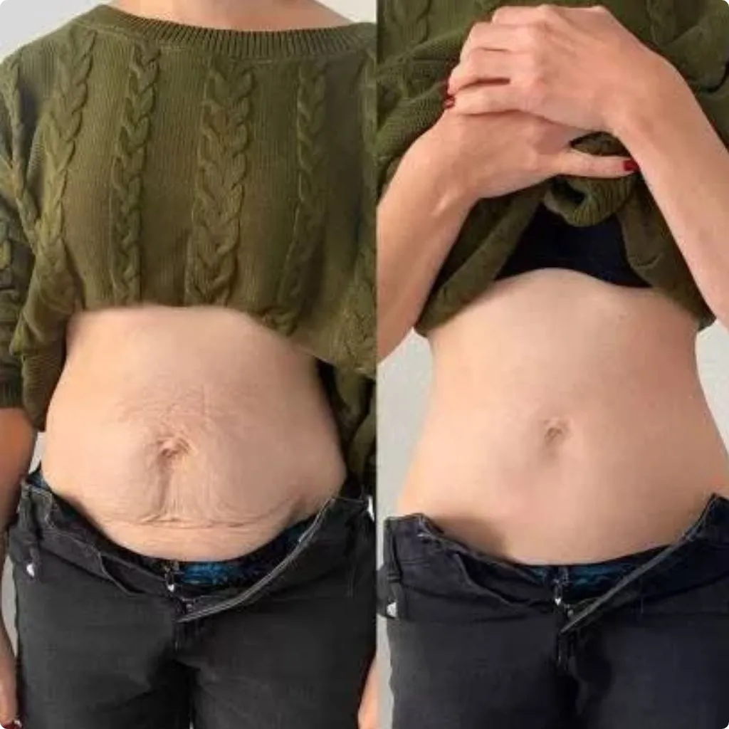 Before Endolift tummy treatment