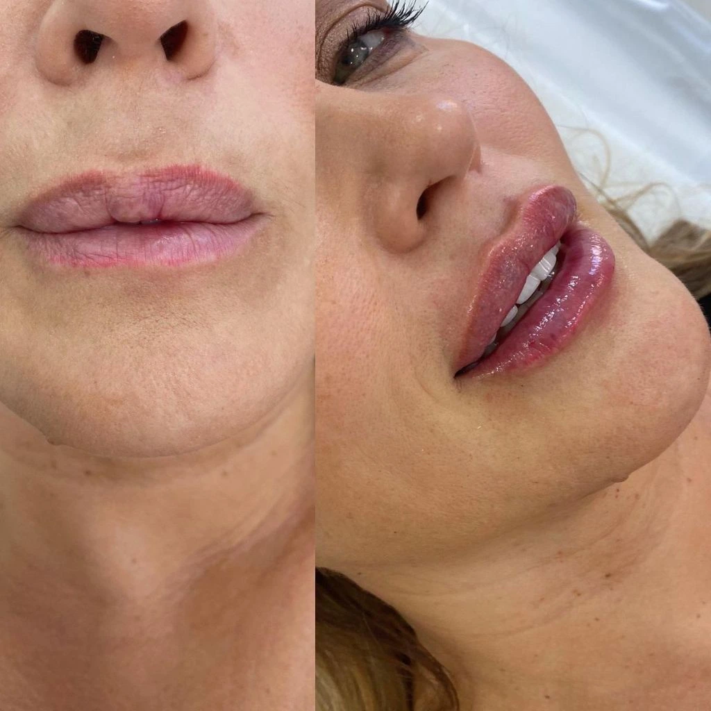 Before after PRF lip augmentation