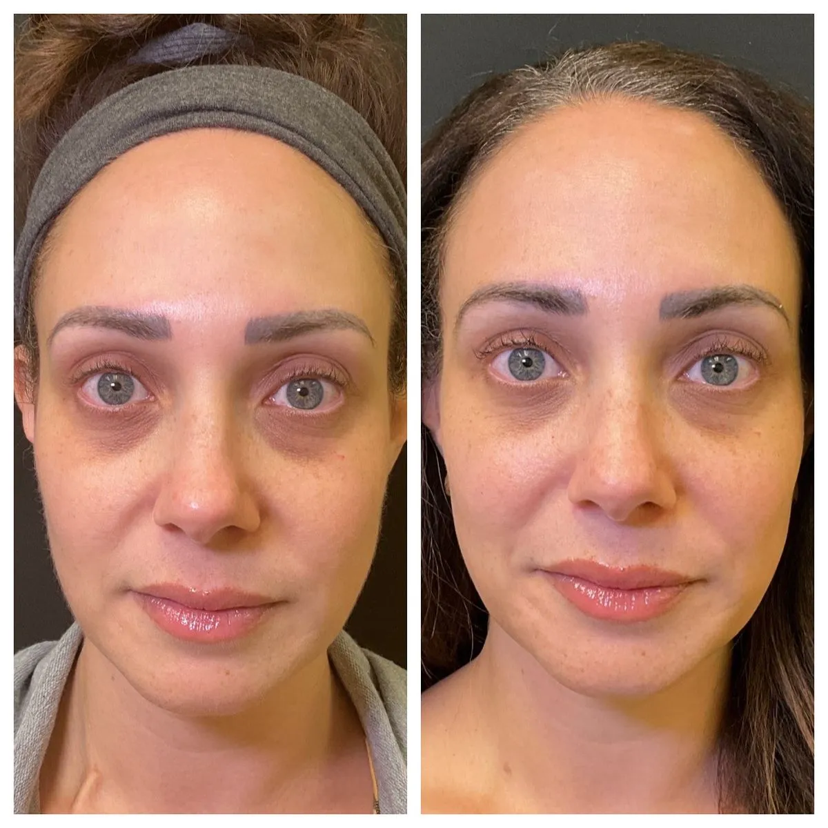 Before after PRF treatment for dark circles