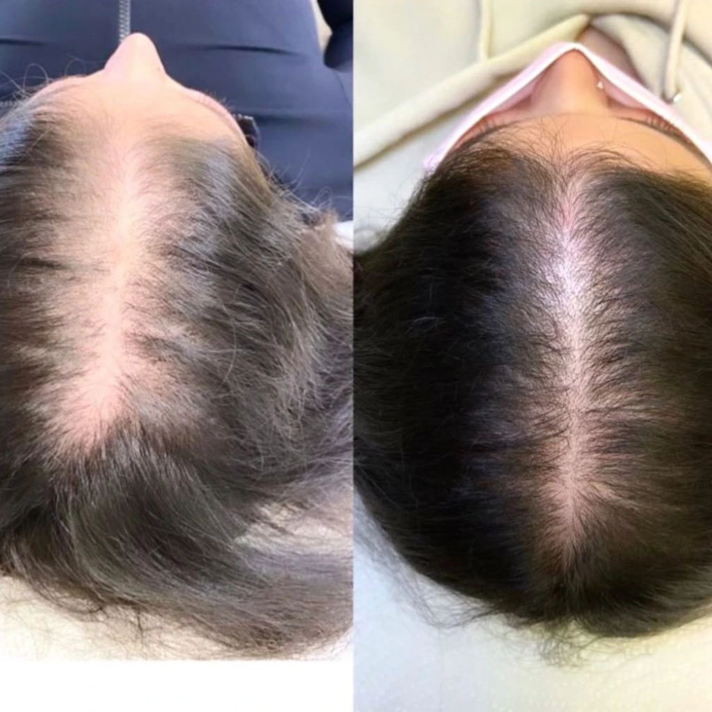 PRF hair loss treatment results Dubai