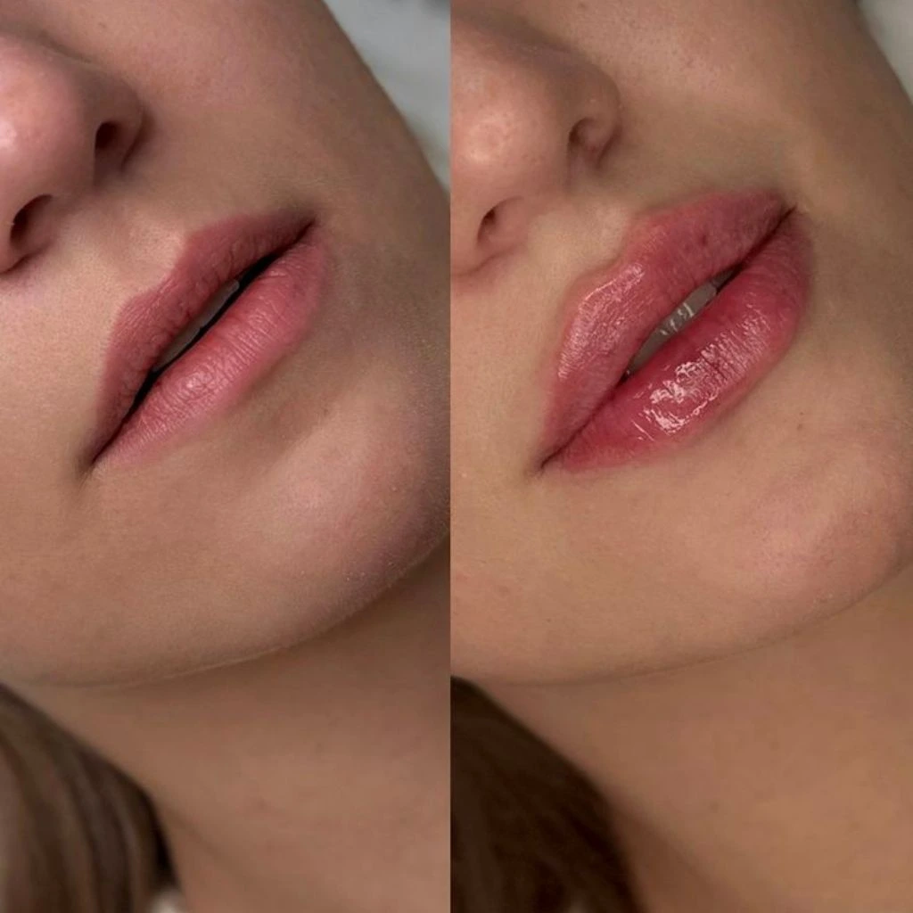 Before and after PRF lip treatment results