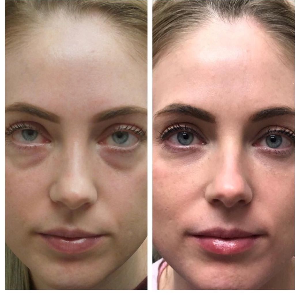 Before and after PRF under eye treatment results