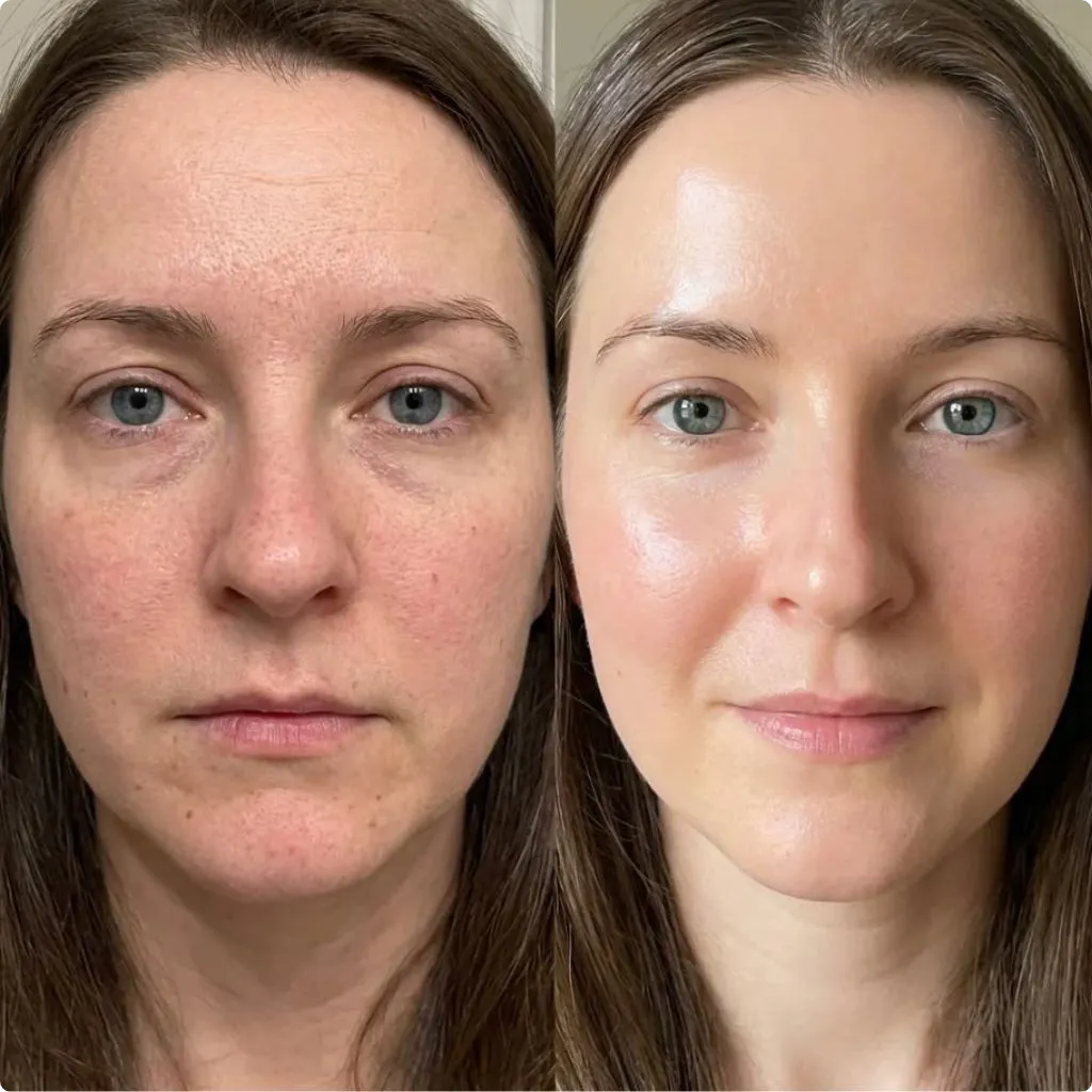 Before and after PRP facial treatment results