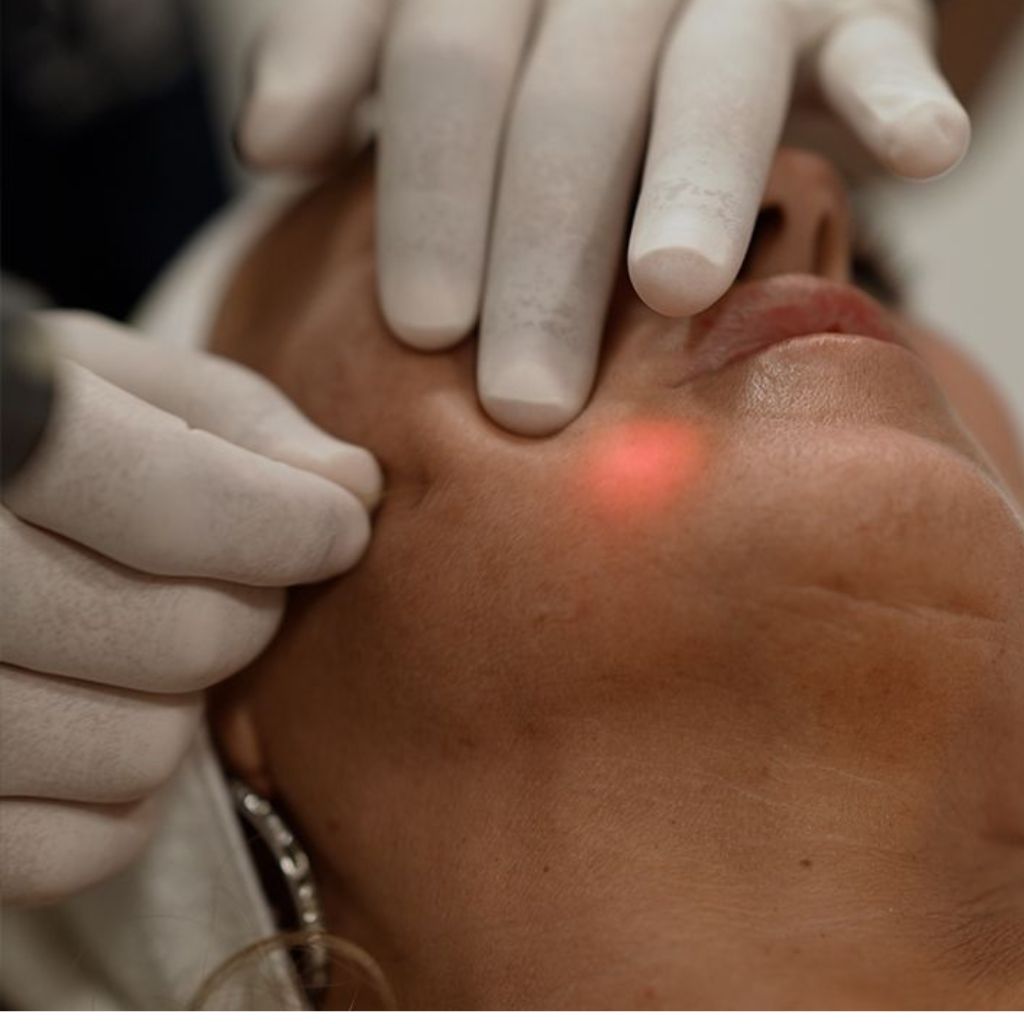 Face Endolift results Dubai