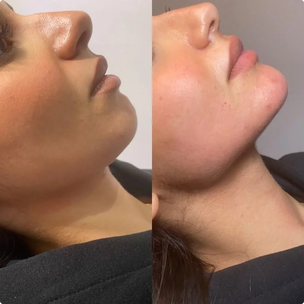 Before and after results of jawline filler