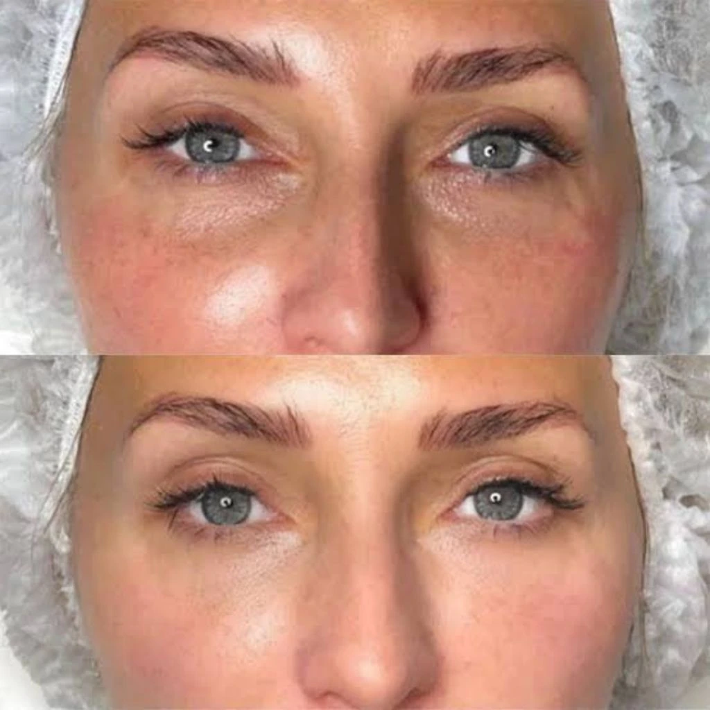 (Biofiller) Before and After Results