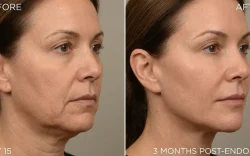 Endolift Before and After