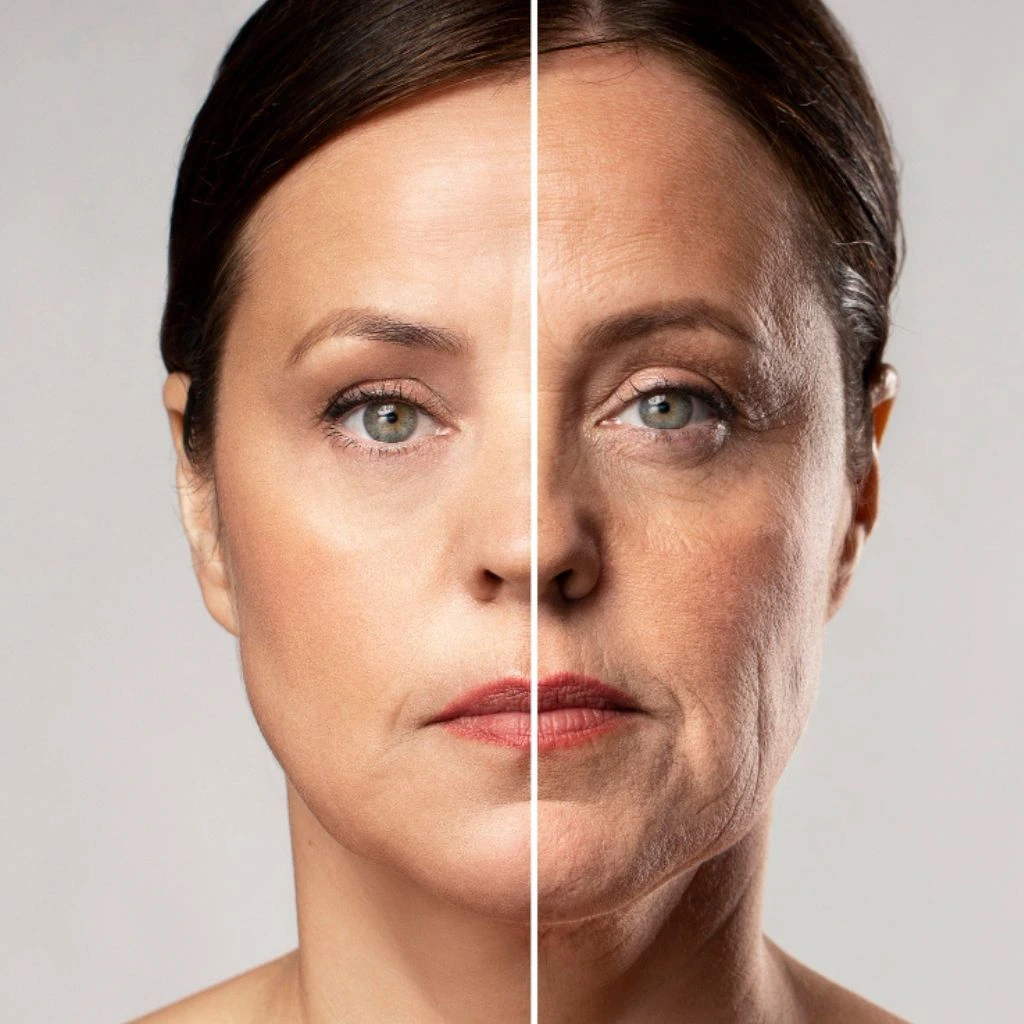 Endolift Before and After Results